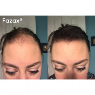 Fazax, Средство для стимуляции роста волос Depixil 15%